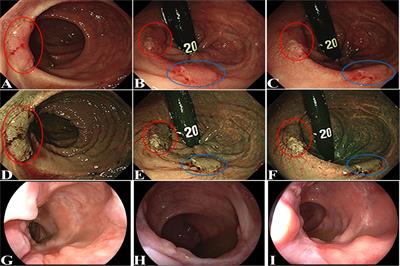 Implantation metastasis from sigmoid colon cancer to rectal anastomosis proved by whole exome sequencing and lineage inference for cancer heterogeneity and evolution analysis: Case report and literature review